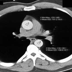 Test Bolus Technique for Coronary CTA - CTisus CT Scan