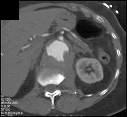 Aortic Aneurysm With Ulceration of Exterior of the Spine - CTisus CT Scan