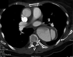 Aortic Dissection - CTisus CT Scan