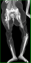 Small Vessels in Thigh and Calf - CTisus CT Scan