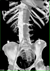 IVC Enhancement Through A Femoral Line - CTisus CT Scan