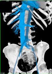 Vascular Editing Tool - CTisus CT Scan