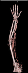 Patent Av Shunt for Dialysis - CTisus CT Scan