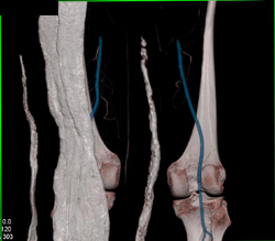 CTA Knee Sp Trauma With Normal Popliteal Aa - CTisus CT Scan