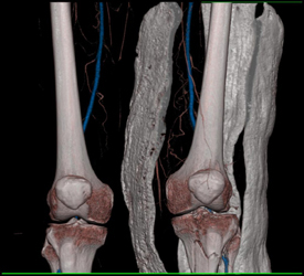 Vessel Isolation Tool - CTisus CT Scan