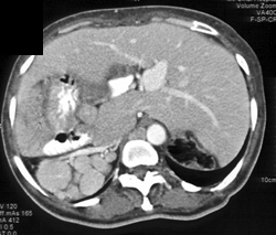 Situs Inversus With Polysplenic - CTisus CT Scan