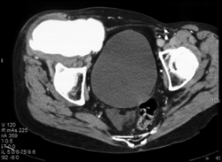 Giant Femoral Pseudoaneurysm - CTisus CT Scan