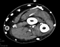 Occluded Dialysis Graft Site - CTisus CT Scan