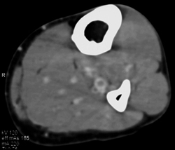 Thrombosal Vein - CTisus CT Scan