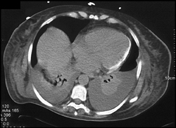 Calcified Myocardium in Renal Failure - CTisus CT Scan