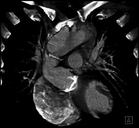 Aortic Valve Replacement - CTisus CT Scan