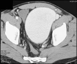 Arteriovenous (AV) Fistulae Thigh With Pelvic Venous Varix 12 Years Sp GSW - CTisus CT Scan