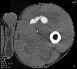 GSW With Femoral Aa Pseudoaneurysm - CTisus CT Scan