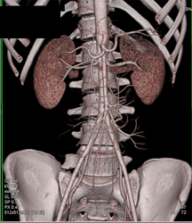 Normal CTA With Example of Vessel Segmentation - CTisus CT Scan