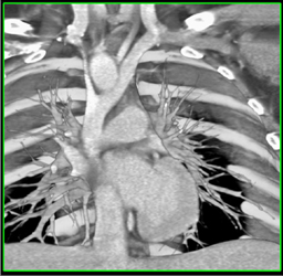 Right Sided Aortic Arch - CTisus CT Scan