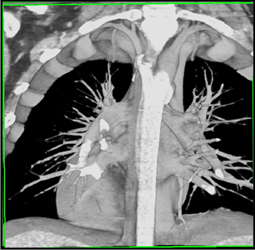 Double Arch Configuration - CTisus CT Scan