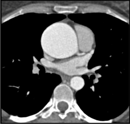 Dilated Aortic Root - CTisus CT Scan