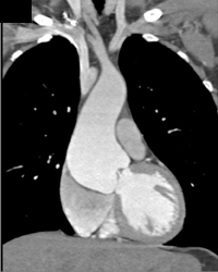 Dilated Aortic Root - CTisus CT Scan