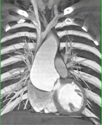 Dilated Aortic Root - CTisus CT Scan