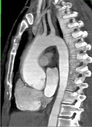 Dilated Aortic Root - CTisus CT Scan