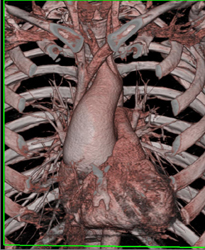 Dilated Aortic Root - CTisus CT Scan