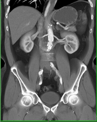 Retroaortic Vein - CTisus CT Scan