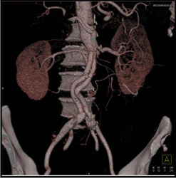 Aortoiliac Stents - CTisus CT Scan