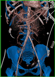 CTA With Nice Illustration of Bone Editing Program - CTisus CT Scan