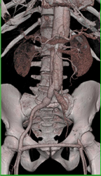 Occluded Left External Iliac Artery With Fem-fem Bypass - CTisus CT Scan