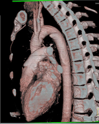 Incomplete Double Aortic Arch With Diverticulum - CTisus CT Scan