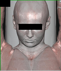 CTA of the Carotids and Jugular Veins - CTisus CT Scan