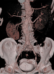 Aortic Aneurysm - CTisus CT Scan