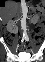 Aortic Aneurysm - CTisus CT Scan