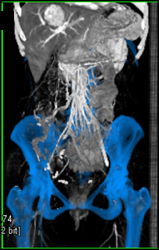 Occluded Right External Iliac Aa - CTisus CT Scan