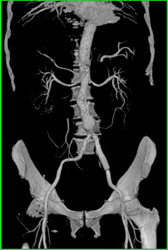 Stent in Left Common Iliac Aa - CTisus CT Scan