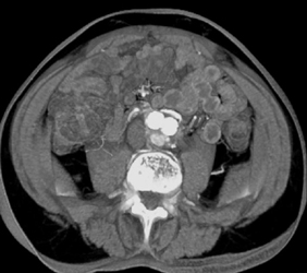 Endoleak From Endovascular Stent - CTisus CT Scan