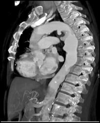 Ulcers in Aortic Aneurysm - CTisus CT Scan