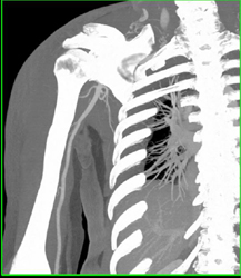 Patent Axillary Aa - CTisus CT Scan