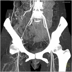 Occluded Right Common Iliac Aa - CTisus CT Scan