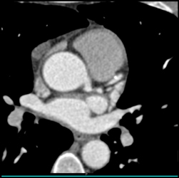 Calcified Plaque in LAD - CTisus CT Scan