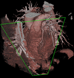 Calcified Plaque in LAD - CTisus CT Scan