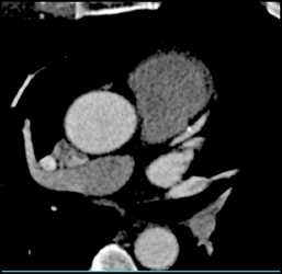 Calcified Plaque in LAD - CTisus CT Scan