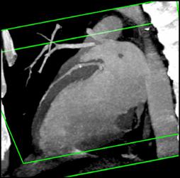 Calcified Plaque in LAD - CTisus CT Scan