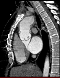 Dilated Aortic Root - CTisus CT Scan