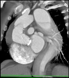 Composite Aortic Valve Replacement - CTisus CT Scan