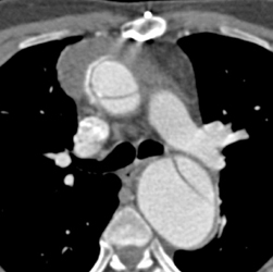 Type A Dissection - CTisus CT Scan