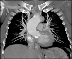 Calcified Aortic Valve - CTisus CT Scan