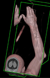 CTA of the Forearm - CTisus CT Scan