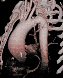 Dilated Ascending Aorta - CTisus CT Scan