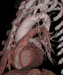 Dilated Ascending Aorta - CTisus CT Scan